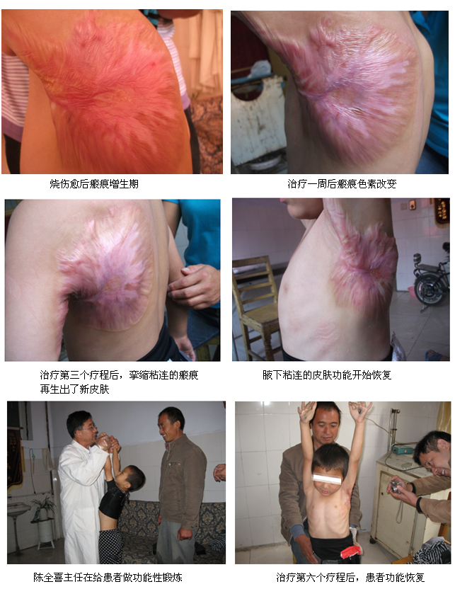 菲彩国际集团_再生回复医疗手艺修复体表瘢痕