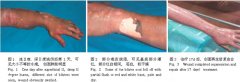 菲彩国际集团_皮肤原位再生回复手艺治疗电弧光烧伤创面的临床体会