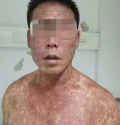 菲彩国际集团_药疹——禁止忽视的皮疹