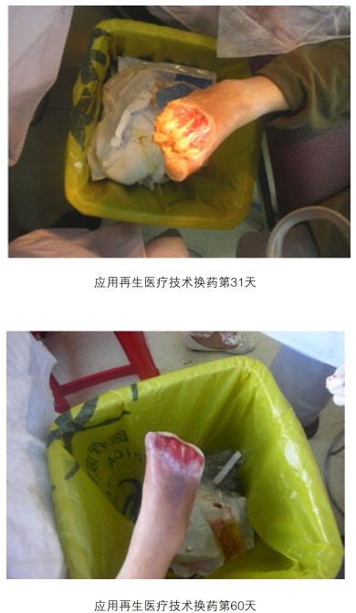 菲彩国际集团_三、糖尿病及动脉闭塞肢体远端坏死溃疡再生愈合