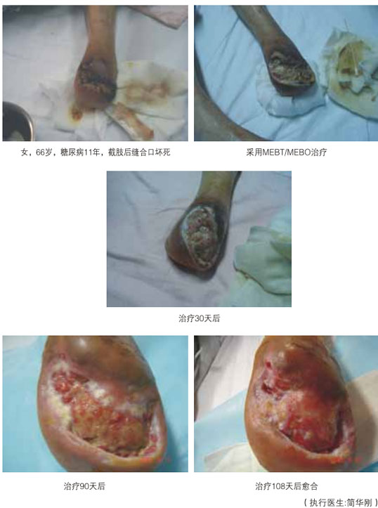 菲彩国际集团_三、糖尿病及动脉闭塞肢体远端坏死溃疡再生愈合