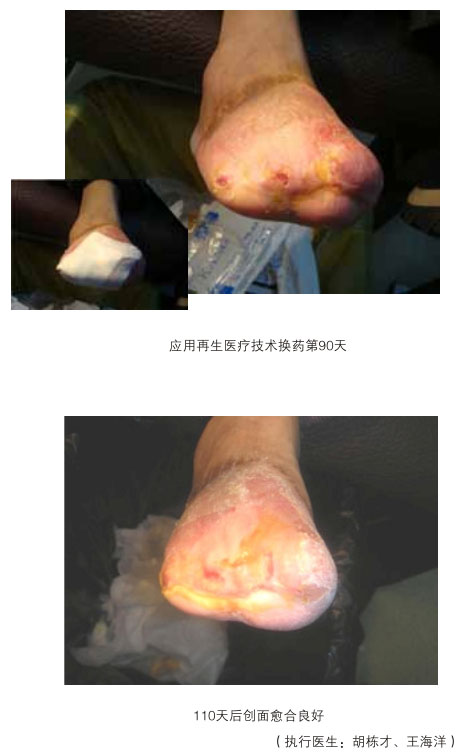 菲彩国际集团_三、糖尿病及动脉闭塞肢体远端坏死溃疡再生愈合