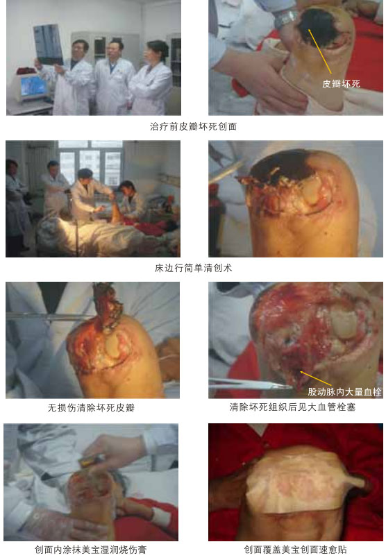 菲彩国际集团_三、糖尿病及动脉闭塞肢体远端坏死溃疡再生愈合