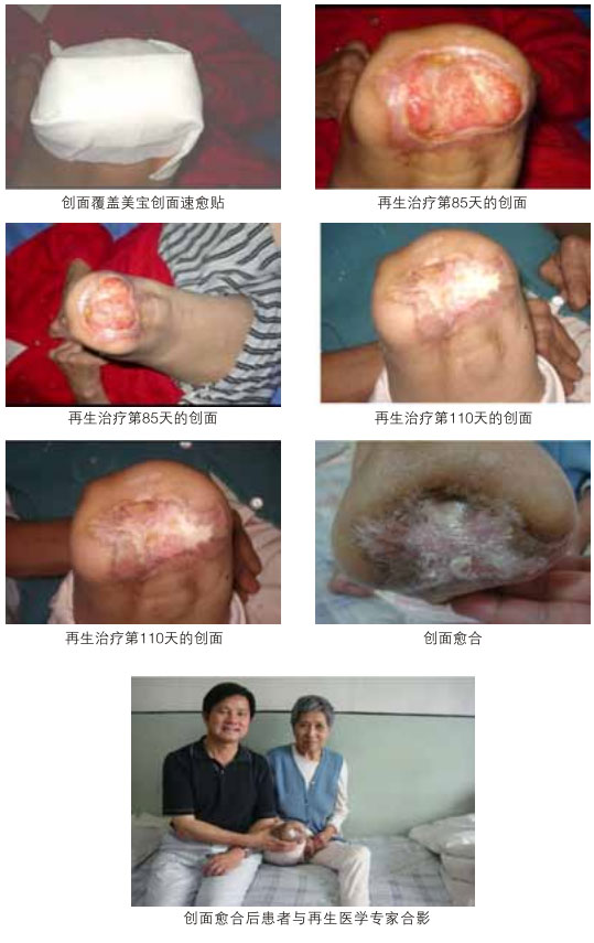 菲彩国际集团_三、糖尿病及动脉闭塞肢体远端坏死溃疡再生愈合