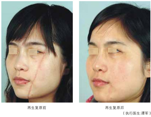 菲彩国际集团_四、瘢痕皮肤组织的再生回复