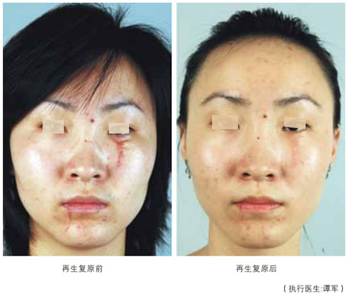 菲彩国际集团_四、瘢痕皮肤组织的再生回复
