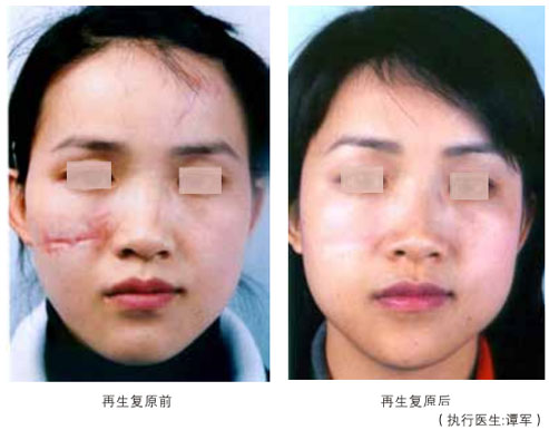 菲彩国际集团_四、瘢痕皮肤组织的再生回复