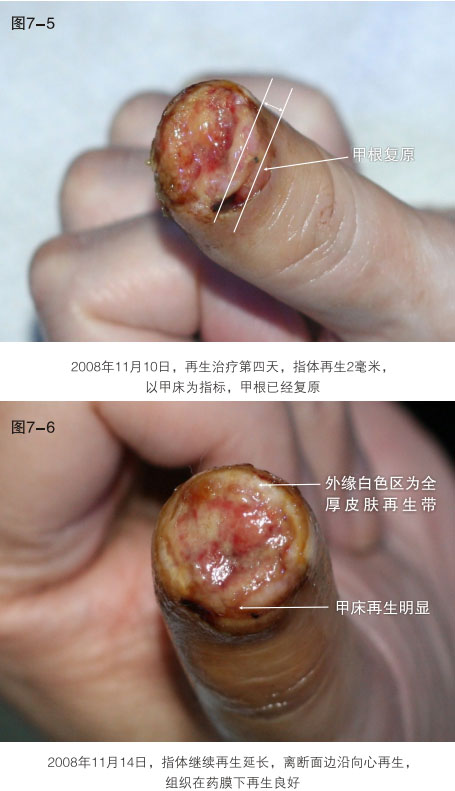 菲彩国际集团_二、断指的再生回复