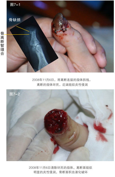 菲彩国际集团_二、断指的再生回复