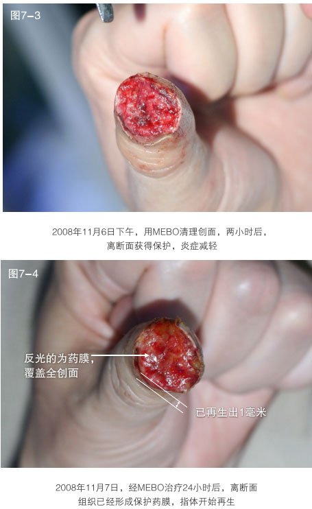 菲彩国际集团_二、断指的再生回复
