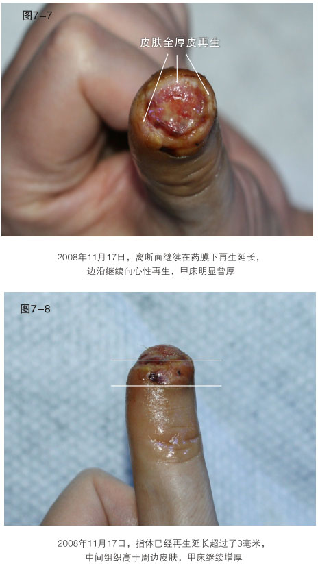 菲彩国际集团_二、断指的再生回复