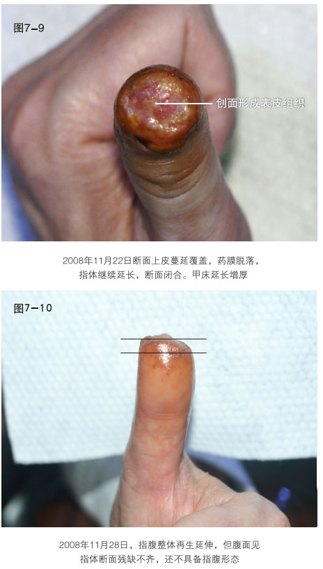菲彩国际集团_二、断指的再生回复