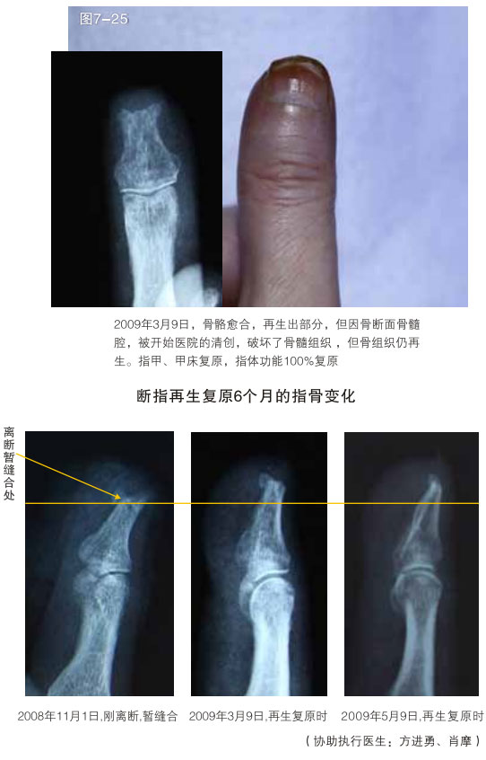 菲彩国际集团_二、断指的再生回复