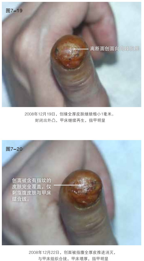 菲彩国际集团_二、断指的再生回复