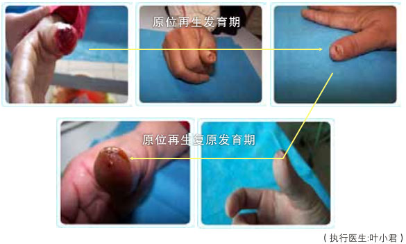 菲彩国际集团_二、断指的再生回复
