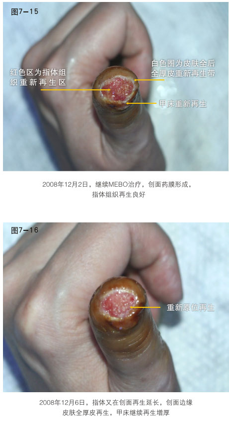 菲彩国际集团_二、断指的再生回复