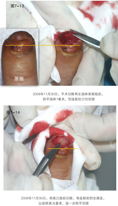 菲彩国际集团_二、断指的再生回复