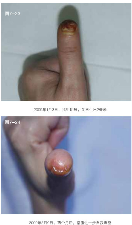 菲彩国际集团_二、断指的再生回复