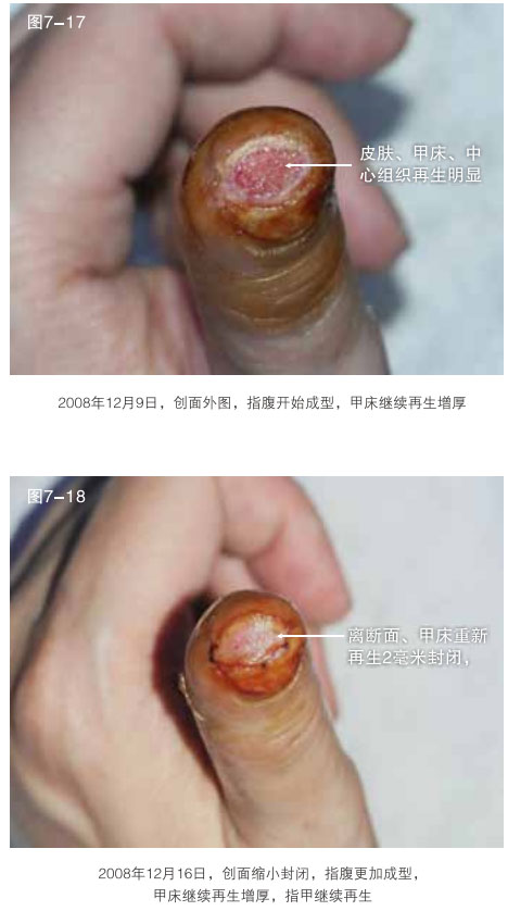 菲彩国际集团_二、断指的再生回复