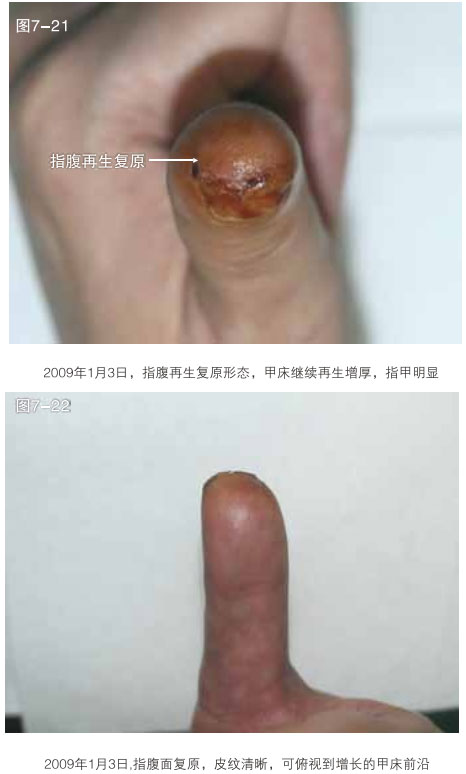 菲彩国际集团_二、断指的再生回复