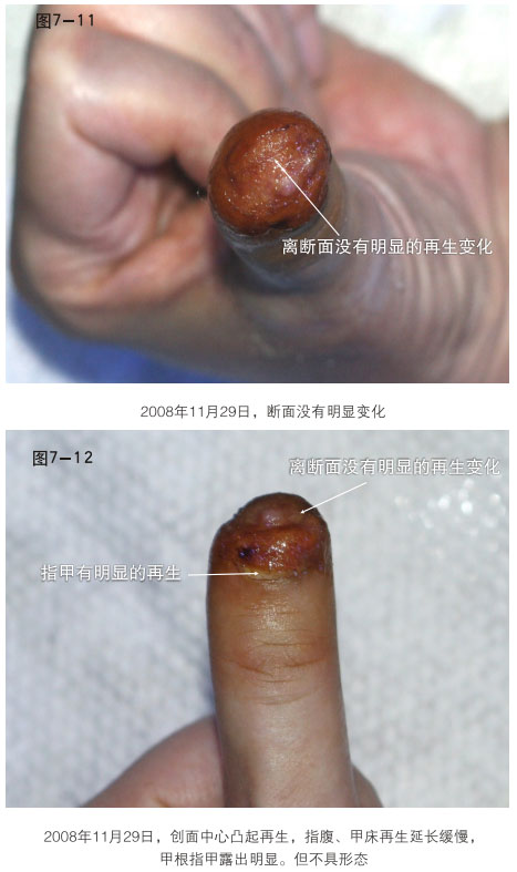 菲彩国际集团_二、断指的再生回复