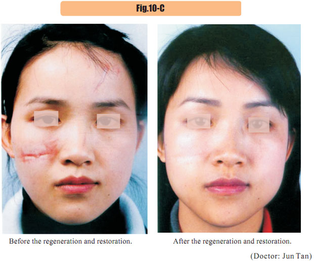 菲彩国际集团_4  Regenerative restoration of skin scar tissues