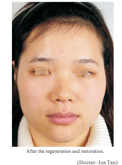 菲彩国际集团_4  Regenerative restoration of skin scar tissues