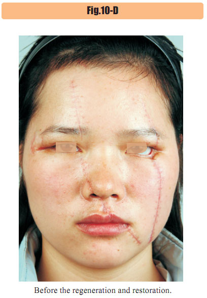 菲彩国际集团_4  Regenerative restoration of skin scar tissues