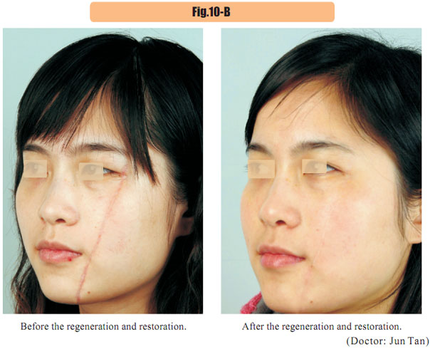 菲彩国际集团_4  Regenerative restoration of skin scar tissues