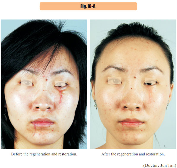 菲彩国际集团_4  Regenerative restoration of skin scar tissues