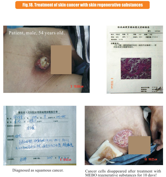 菲彩国际集团_8  Research on rResearch on regenerative anti-cancer