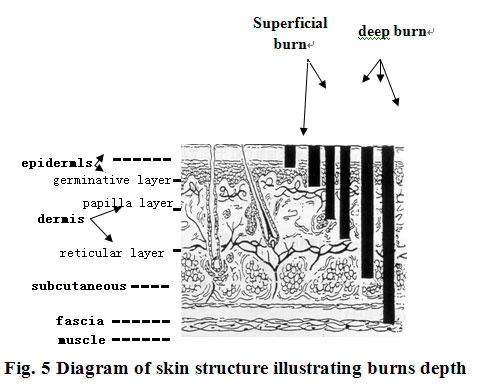 菲彩国际集团_Clinical Evaluation on Depth of the Burns Wound