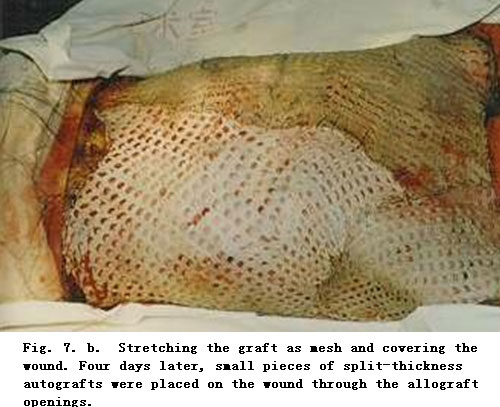 菲彩国际集团_Standardized Local Treatment of Burns Wounds