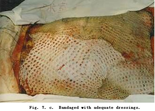菲彩国际集团_Standardized Local Treatment of Burns Wounds