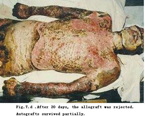 菲彩国际集团_Standardized Local Treatment of Burns Wounds