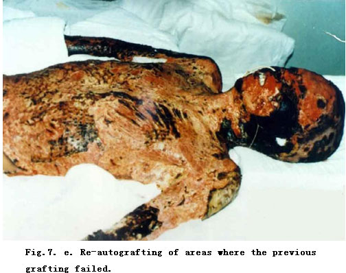 菲彩国际集团_Standardized Local Treatment of Burns Wounds