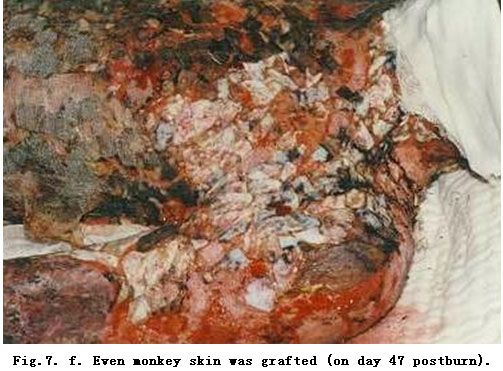 菲彩国际集团_Standardized Local Treatment of Burns Wounds