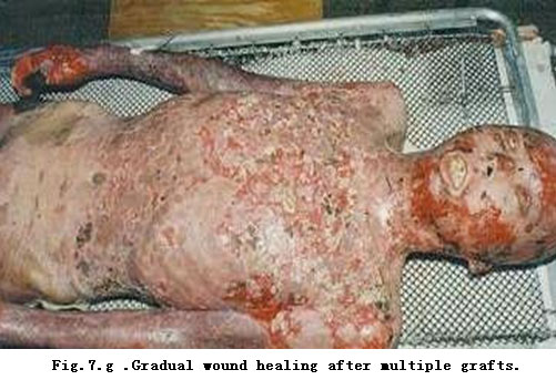 菲彩国际集团_Standardized Local Treatment of Burns Wounds