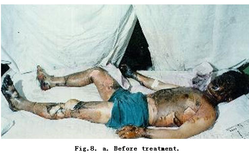 菲彩国际集团_Standardized Local Treatment of Burns Wounds