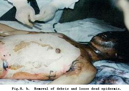 菲彩国际集团_Standardized Local Treatment of Burns Wounds