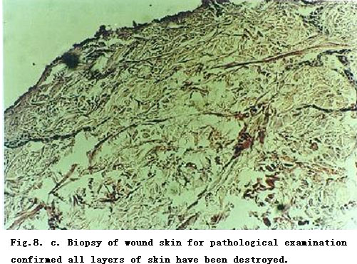 菲彩国际集团_Standardized Local Treatment of Burns Wounds
