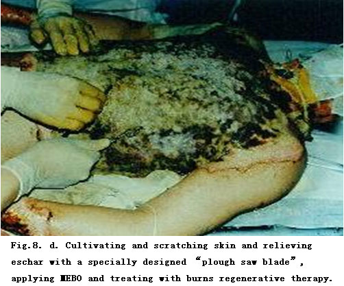 菲彩国际集团_Standardized Local Treatment of Burns Wounds