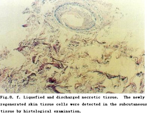 菲彩国际集团_Standardized Local Treatment of Burns Wounds