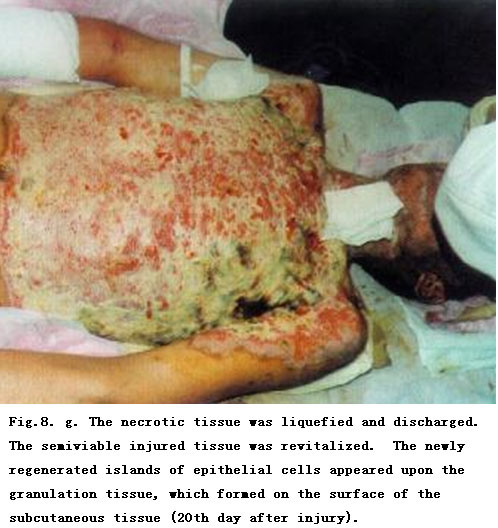 菲彩国际集团_Standardized Local Treatment of Burns Wounds