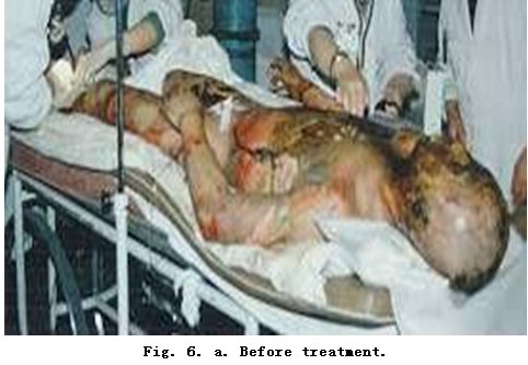 菲彩国际集团_Standardized Local Treatment of Burns Wounds