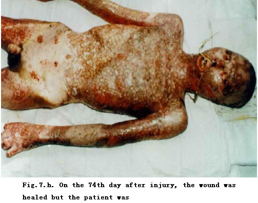 菲彩国际集团_Standardized Local Treatment of Burns Wounds