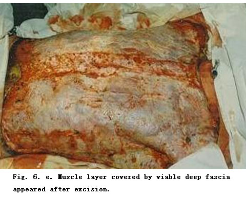 菲彩国际集团_Standardized Local Treatment of Burns Wounds