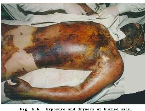 菲彩国际集团_Standardized Local Treatment of Burns Wounds