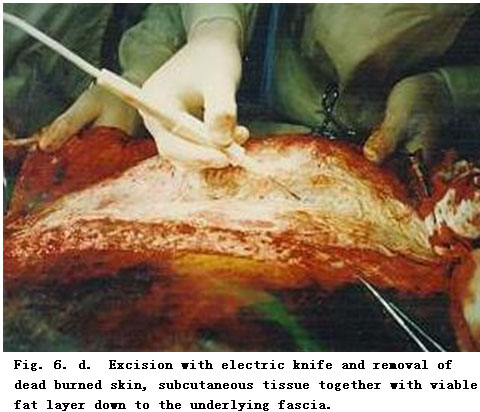 菲彩国际集团_Standardized Local Treatment of Burns Wounds