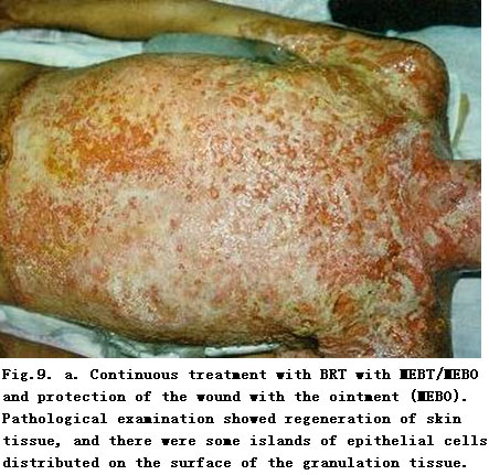 菲彩国际集团_Standardized Local Treatment of Burns Wounds